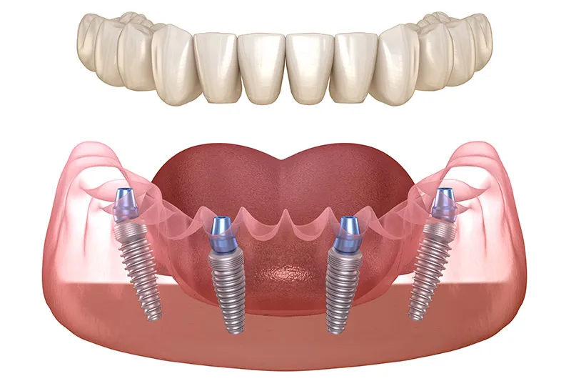 Reabilitare completă All-on-4 — caz realizat la Clinica Dr. Corlade