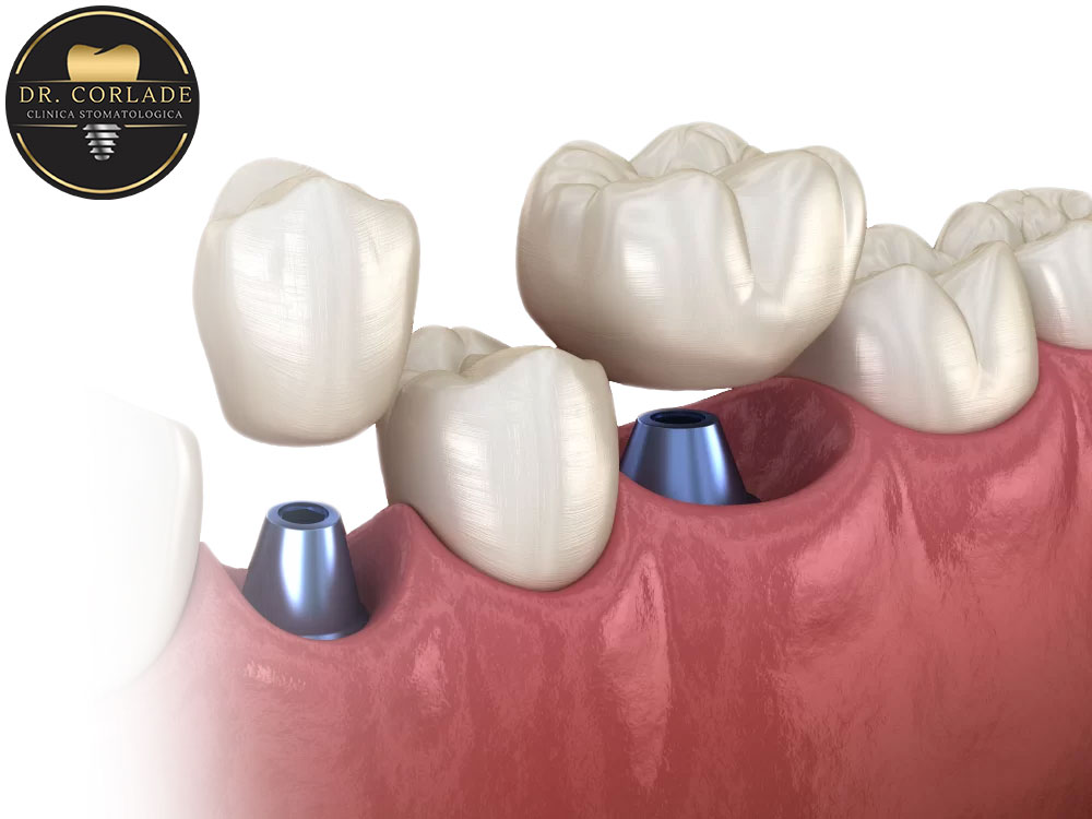 Implant unitar + coroană zirconiu — caz realizat la Clinica Dr. Corlade