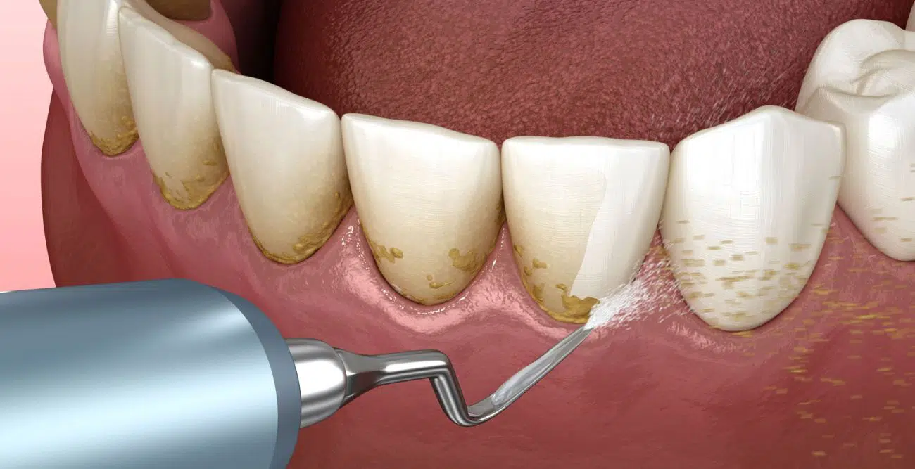 Detartraj dentar cu ultrasunete — Clinica Dr. Corlade