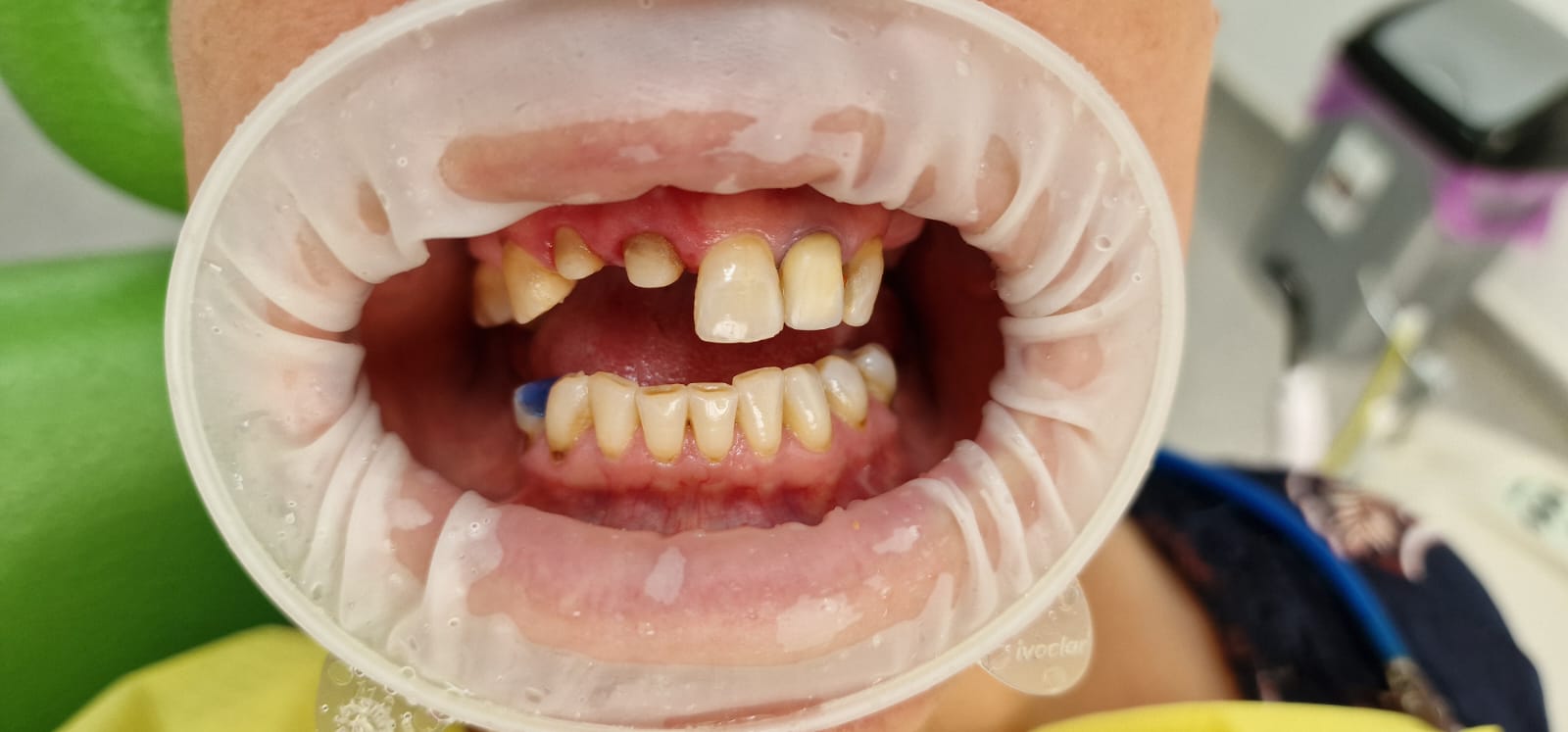 Fațete ceramice E-max — zâmbet estetic — caz realizat la Clinica Dr. Corlade