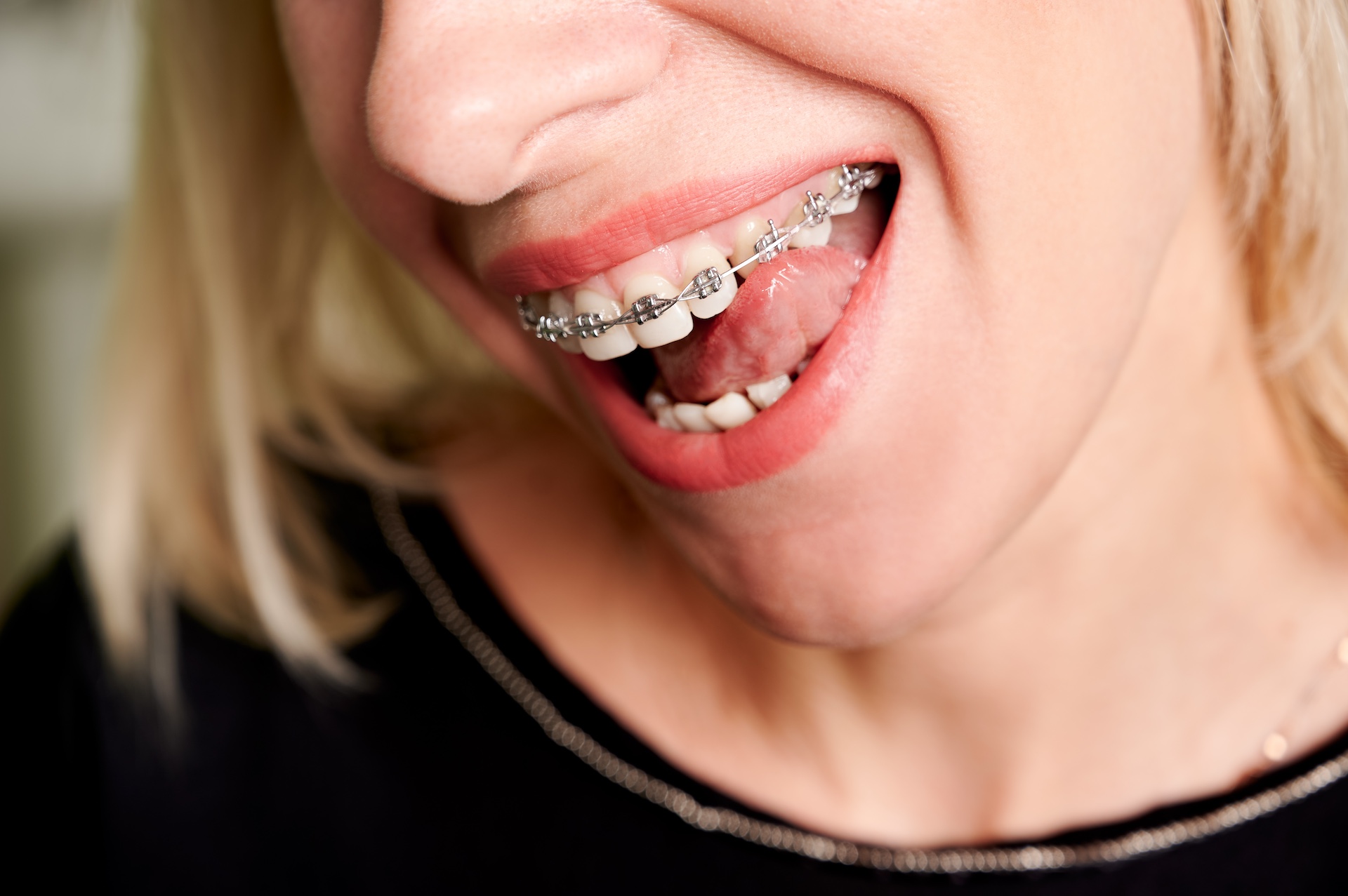Aparat ortodontic fix — aliniere totală — caz realizat la Clinica Dr. Corlade
